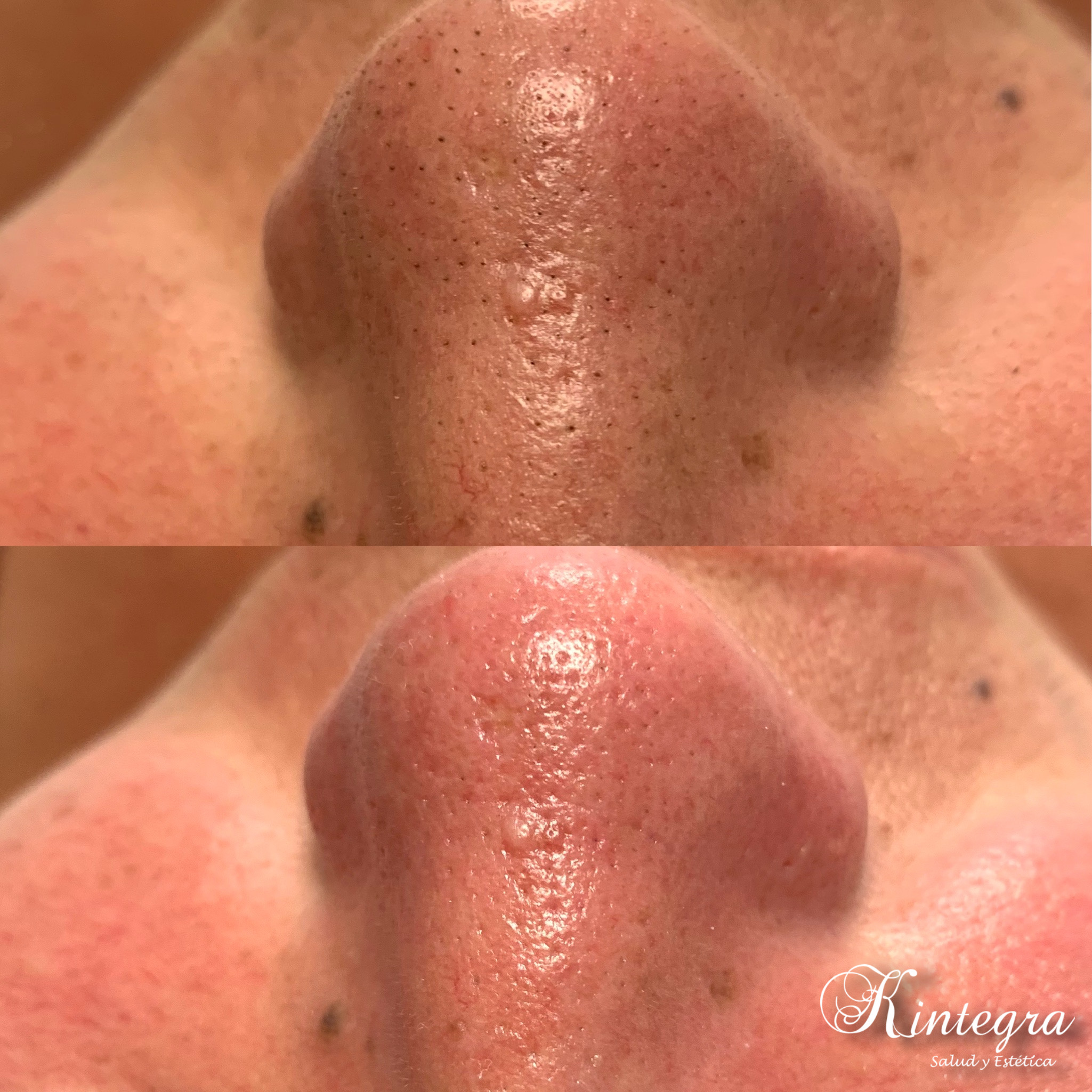 Limpieza facial profunda antes y despues