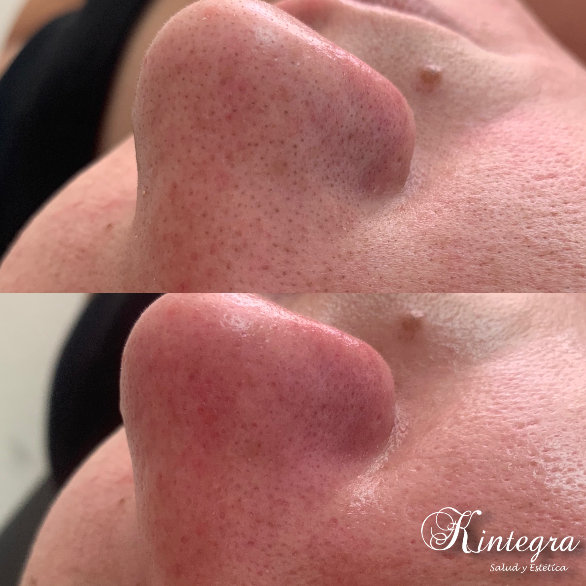 Limpieza facial profunda antes y despues