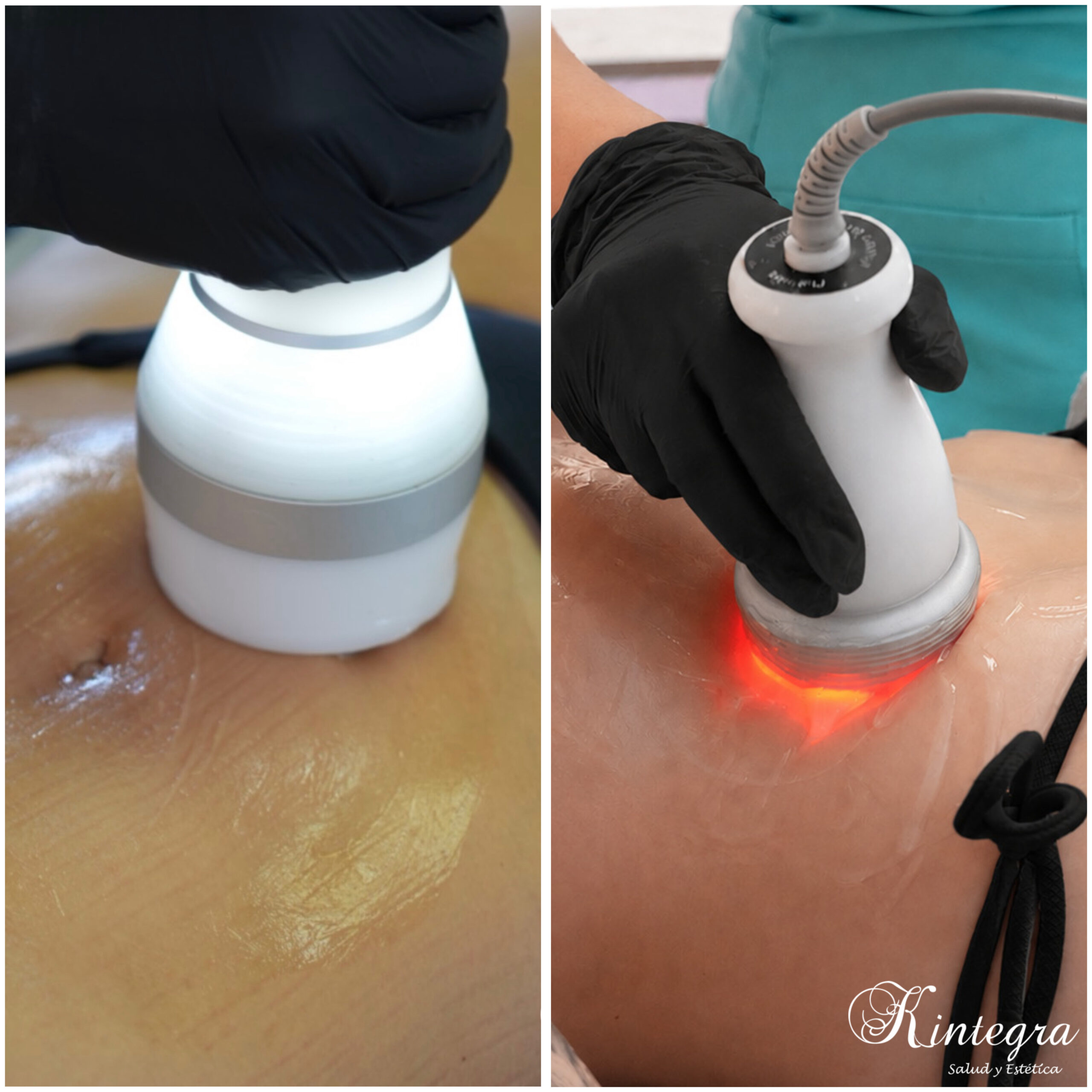 "HImFU + Criofrecuencia" Reduce y reafirma al instante