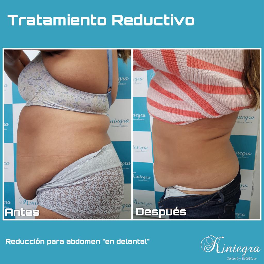Tratamiento Reductivo Combinado (7 sesiones) - Imagen 18