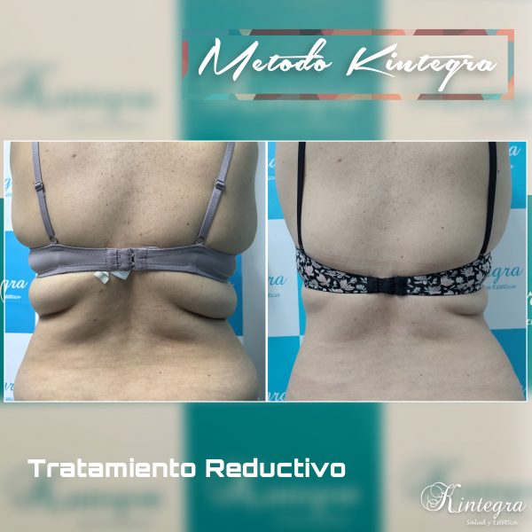 Polarys Gold 360° - 4 Manípulos M o L (Abdomen completo) - Imagen 5