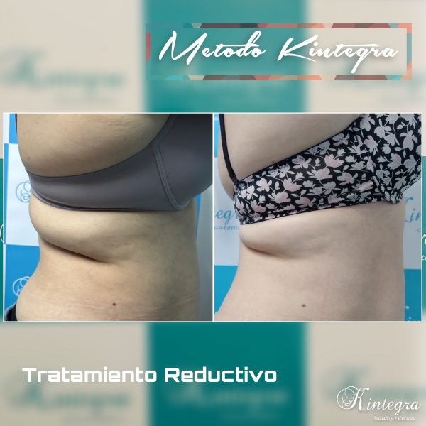 Polarys Gold 360° - 4 Manípulos M o L (Abdomen completo) - Imagen 4