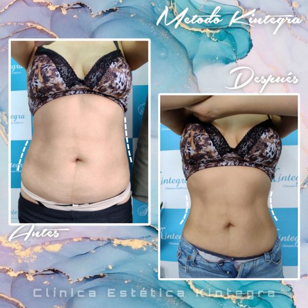 Polarys Gold 360° - 4 Manípulos M o L (Abdomen completo) - Imagen 7