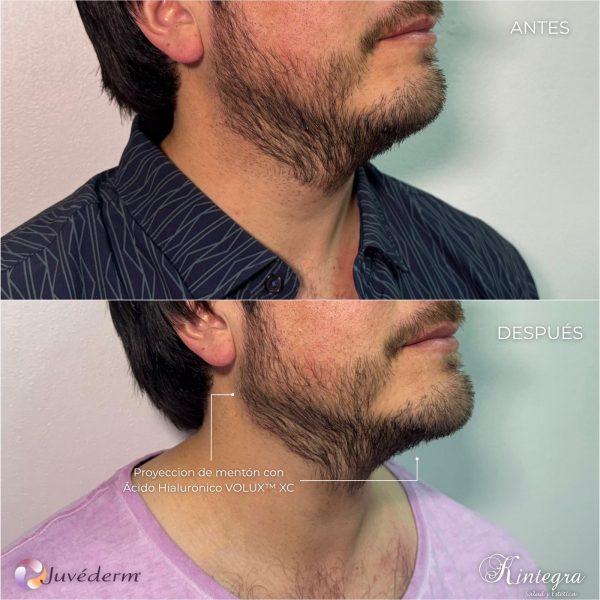 Volux® para Mentón y/o Mandíbula Masculina